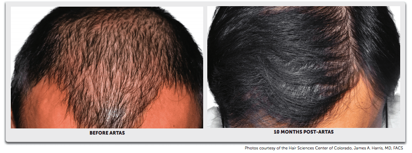 Before and After Hair Transplant1