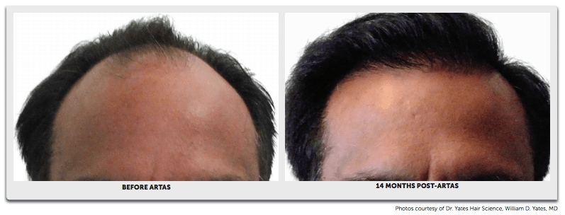Before and After Hair Transplant2