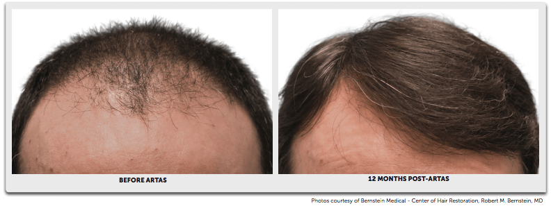 Before and After Hair Transplant3